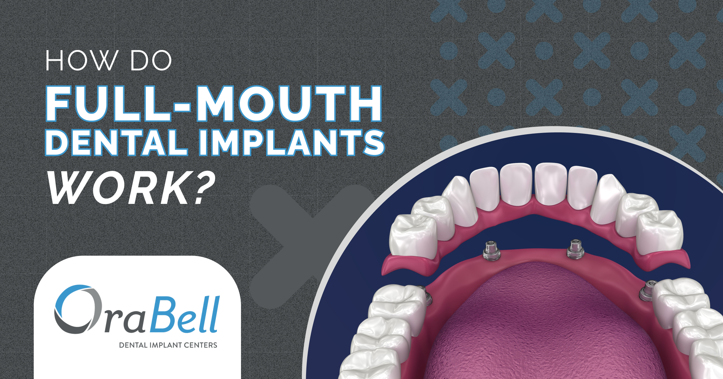 Full-Mouth Dental Implants