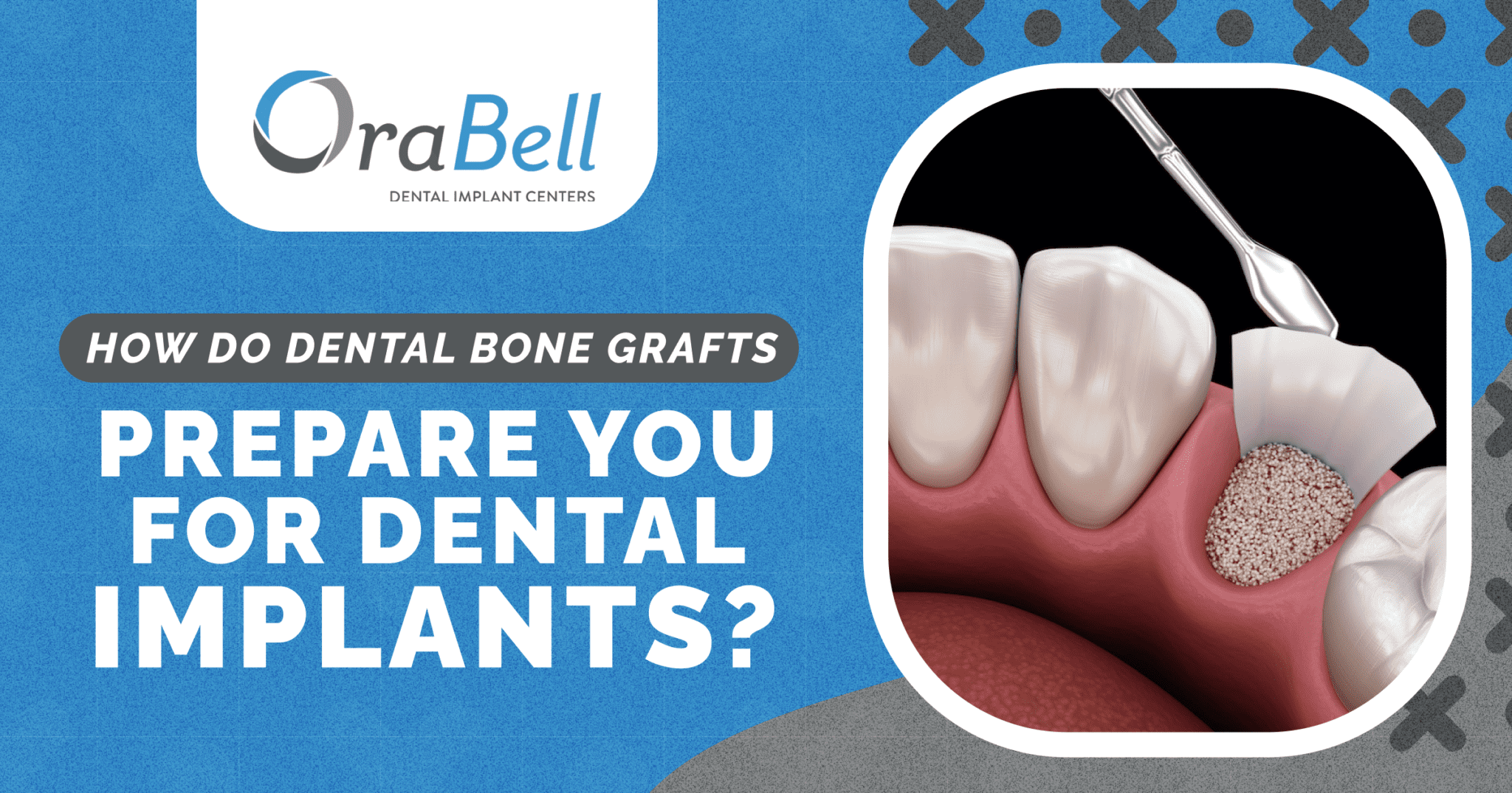 How Do Dental Bone Grafts Prepare You for Dental Implants? OraBell