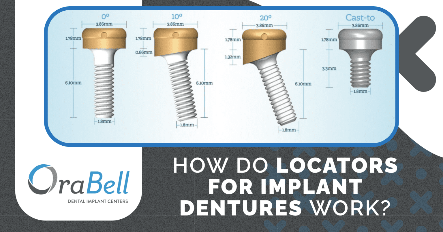 How Do Locators For Implant Dentures Work? - Orabell Dental Implants